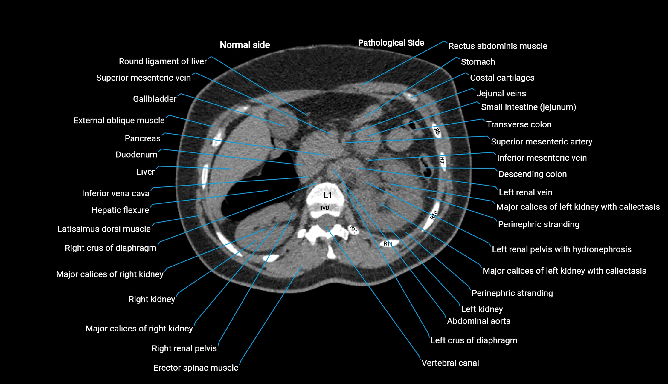 CT KUB axial cross sectional anatomy  radiology image -img-00201-00037.webp